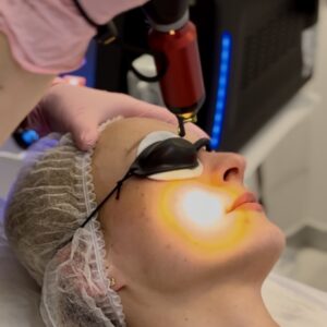 Usuwanie przebarwień, plam starczych, laser pikosekundowy